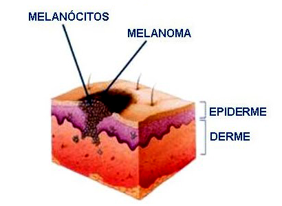 cancer de pele solar