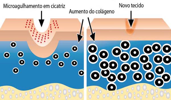 tratamento de microagulhamento cutâneo para cicatriz, rugas, estrias e manchas na pele