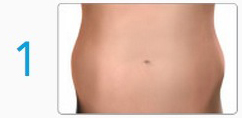 CoolSculpting 1