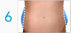 Coolsculpting 6