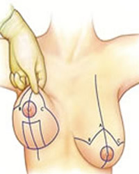 cirurgia plastica de mamas