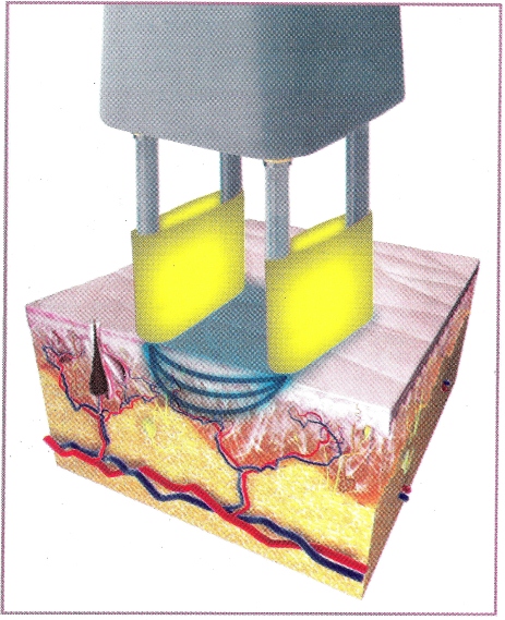 tratamento a laser