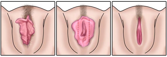 mamoplastia barra da tijuca